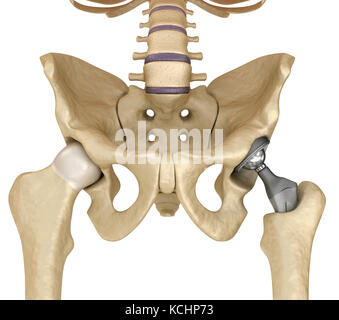 Hüftgelenkersatz-Implantat in den Knochen des Beckens installiert. Medizinisch genaue 3D-Illustration Stockfoto