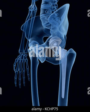 Hüftprothetik im Beckenknochen. Röntgenansicht. Medizinisch akkurates 3D Stockfoto