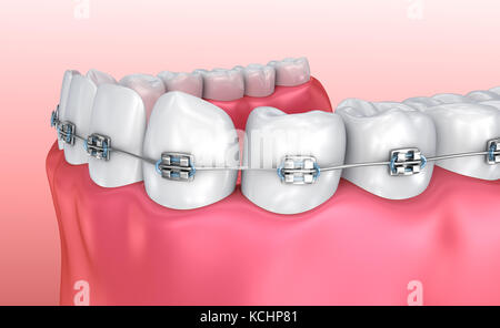 Zähne mit Zahnspangen isoliert auf weiss. Medizinisch genaue 3D-Illustration Stockfoto