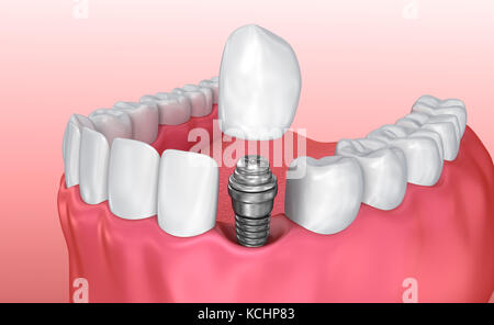 Zahn instalation Prozess Implantat, Medizinisch genaue 3D-Abbildung weiß Stil Stockfoto