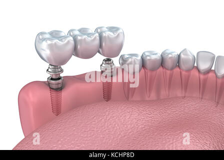 Unteren Zähne und Zahnimplantate transparent machen isoliert auf weiss. 3D illustration Stockfoto