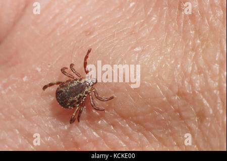 American Dog Tick, Dermacentor variabilis, auf die Haut. Gefunden nachdem man durch hohes Gras im Frühling, Saskatchewan, Kanada Stockfoto