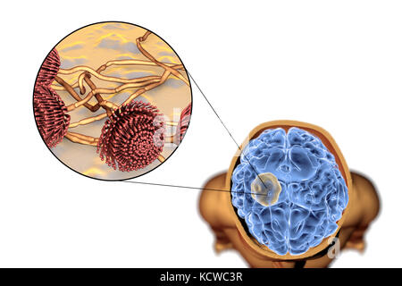 Aspergilloma des Gehirns und Nahaufnahme von Aspergillus Pilze, computer Abbildung. Auch als myzetom oder Pilz ball bekannt, dies ist eine intrakranielle Läsion durch Aspergillus Pilze bei immunsupprimierten Patienten hergestellt. Stockfoto