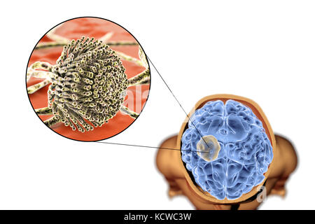 Aspergilloma des Gehirns und Nahaufnahme von Aspergillus Pilze, computer Abbildung. Auch als myzetom oder Pilz ball bekannt, dies ist eine intrakranielle Läsion durch Aspergillus Pilze bei immunsupprimierten Patienten hergestellt. Stockfoto