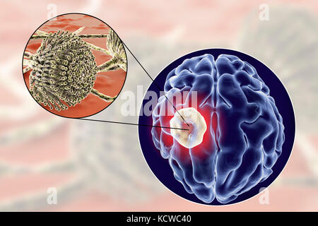 Aspergilloma des Gehirns und Nahaufnahme von Aspergillus Pilze, computer Abbildung. Auch als myzetom oder Pilz ball bekannt, dies ist eine intrakranielle Läsion durch Aspergillus Pilze bei immunsupprimierten Patienten hergestellt. Stockfoto