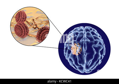 Aspergilloma des Gehirns und Nahaufnahme von Aspergillus Pilze, computer Abbildung. Auch als myzetom oder Pilz ball bekannt, dies ist eine intrakranielle Läsion durch Aspergillus Pilze bei immunsupprimierten Patienten hergestellt. Stockfoto