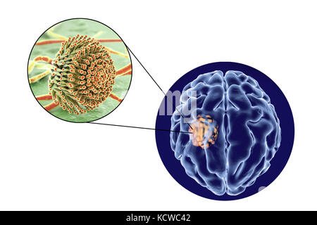 Aspergilloma des Gehirns und Nahaufnahme von Aspergillus Pilze, computer Abbildung. Auch als myzetom oder Pilz ball bekannt, dies ist eine intrakranielle Läsion durch Aspergillus Pilze bei immunsupprimierten Patienten hergestellt. Stockfoto