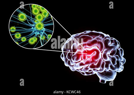 Virale Enzephalitis. Konzeptionelle Abbildung: Gehirn und Nahaufnahme der Viren Nervenzellen zu infizieren. Stockfoto