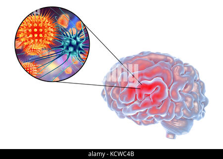Virale Enzephalitis. Konzeptionelle Abbildung: Gehirn und Nahaufnahme der Viren Nervenzellen zu infizieren. Stockfoto