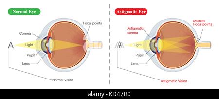 Vision der normalen Auge und astigmatic Stock Vektor