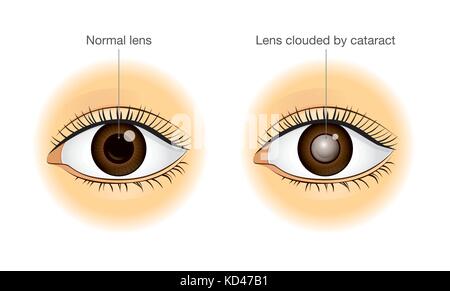 Normale Augen und Linse von Katarakt getrübt. Stock Vektor