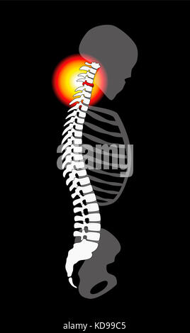 Wirbelsäule Bandscheibenvorfall - Nackenschmerzen durch Halswirbelsäule verursacht - Profil anzeigen. Abbildung auf schwarzen Hintergrund. Stockfoto
