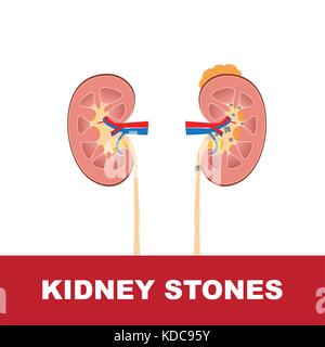 Vector Illustration von Nierensteinen und Gesundheit Niere Stock Vektor