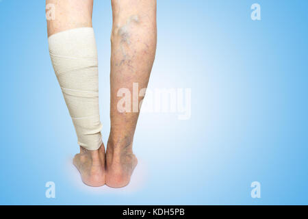 Beine. Krampfadern. phlebeurysm. Thrombophlebitis. Elastische Bandage Stockfoto