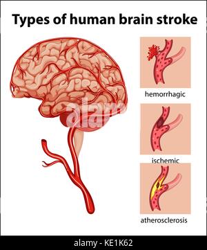 Arten des menschlichen Gehirns Schlaganfall Abbildung Stock Vektor