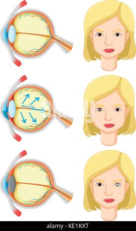 Diagramm mit Auge Problem in der menschlichen Abbildung Stock Vektor