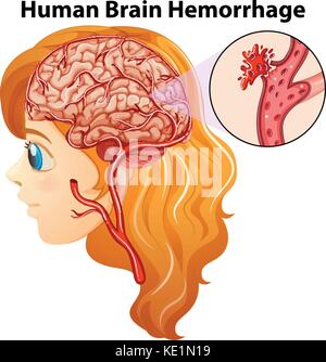 Diagramm mit menschlichen Hirnblutung Abbildung Stock Vektor