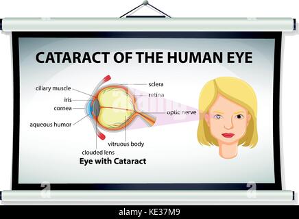 Diagramm, Katarakt des menschlichen Auges Abbildung Stock Vektor