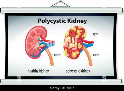 Niere - polyzystische Erkrankung Stockfoto, Bild: 130806341 - Alamy
