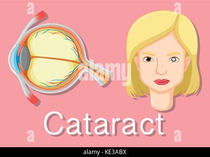 Diagramm mit ungesunden Auge mit Katarakt Abbildung Stock Vektor