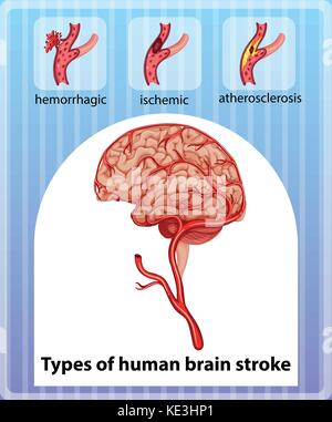 Arten des menschlichen Gehirns Schlaganfall Abbildung Stock Vektor