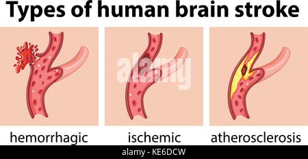 Arten des menschlichen Gehirns Schlaganfall Abbildung Stock Vektor