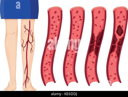 Blutgerinnsel in den Beinen Abbildung (tiefen Vene thombosis) Stock Vektor