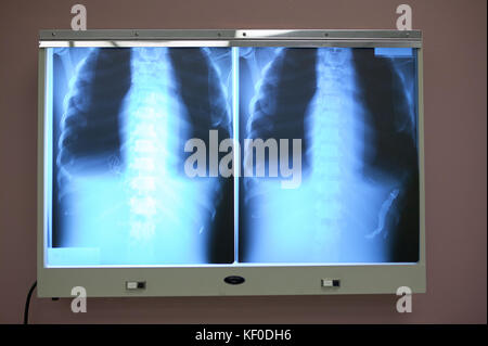 Brust, Brustkorb und Thorax x-ray auf einem Leuchtkasten in einem Krankenhaus für die Erkennung von Frakturen oder Krankheit bei einem Patienten Stockfoto