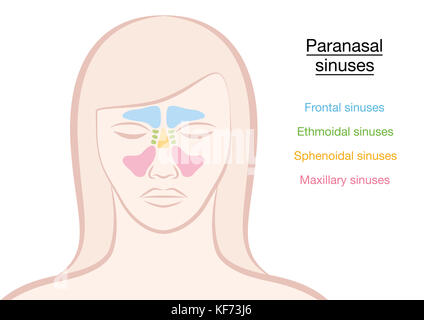 Nasennebenhöhlen auf einem womans Gesicht in verschiedenen Farben - frontal, ethmoidal, sphenoidal und Kieferhöhlen. Abbildung auf weißen Hintergrund. Stockfoto