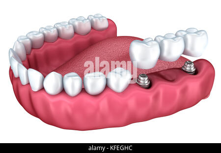 Zahn instalation Prozess Implantat, Medizinisch genaue 3D-Abbildung weiß Stil Stockfoto