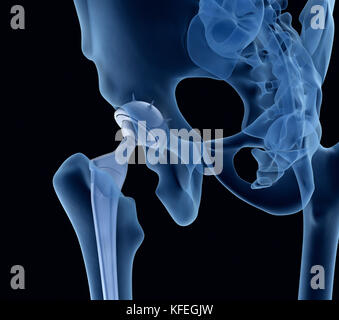 Hüftgelenkersatz-Implantat in den Knochen des Beckens installiert. Röntgenblick. Medizinisch genaue 3D-Illustration Stockfoto