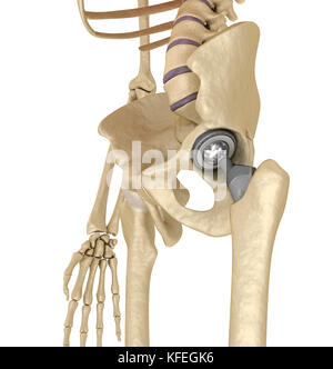 Hüftgelenkersatz-Implantat in den Knochen des Beckens installiert. Medizinisch genaue 3D-Illustration Stockfoto