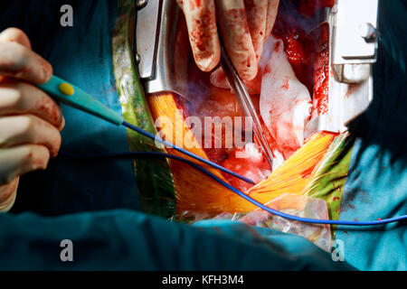 Minimal invasive chirurgische Ansatz mit einem kleinen Schnitt für Herz Ventil Chirurgie für den Ausbau erweiterbar transcatheter Aortic valve Implantation rem Stockfoto