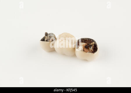 Beschädigte cermet Prothese mit gebrochenen Teile der Zähne Stockfoto