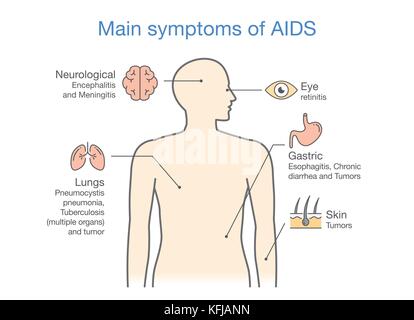 Darstellung der wichtigsten Symptome von Aids. Stock Vektor