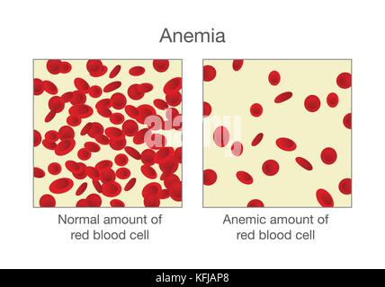 Der Unterschied von normalen roten Blutkörperchen und Anämie. Stock Vektor
