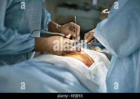 Assistant ist eine chirurgische Aufroller beim Arzt ist mit einem Laser, Skalpell und Pinzette während der Abdominal- Betrieb. des Patienten Magen Abdeckung Stockfoto