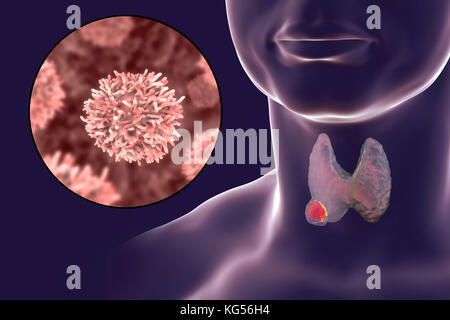 Die menschliche Schilddrüse zeigen einen Tumor und Nahaufnahme der Schilddrüse Krebszellen, computer Abbildung. Stockfoto