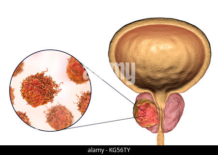 Prostatakrebs. Computer Abbildung eines cancerous Tumor in der Prostata (rechts) und in der Nähe der Prostata Krebszellen (links). Die harnröhre können gesehen werden in der Mitte der Prostata, von der Blase (oben). Prostatakrebs ist eine der häufigsten männlichen Krebse, das gewöhnlich die älteren Menschen. Das Wachstum der Prostata Tumor kann behindern den Hals der Blase, Wasserlassen beeinträchtigt. Es ist jedoch ein langsam wachsender Krebs. Wenn Sie bestimmt, Behandlung beinhaltet die Operation der Prostata zu entfernen, oder Strahlentherapie. Stockfoto