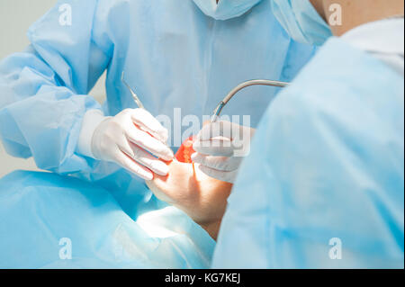 Nahaufnahme der zahnärztlichen Chirurgie Prozess - Implantation. Zahnarzt Chirurg mit Assistant in der modernen Klinik. Stomatologie und Health Care Konzept. Selektive konzentrieren. Stockfoto