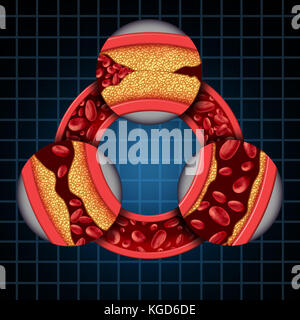 Arterie Krankheit Symptome Diagramm koronare medizinisches Konzept als Rundschreiben Vene mit fortschreitenden Plaquebildung in verstopften Arterien führt. Stockfoto