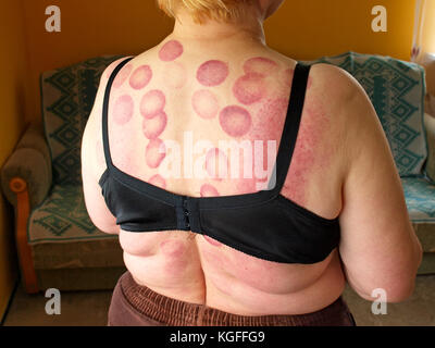 Dunkle rote Kreis Flecken auf dem Rücken der Frau Haut nach medizinischen schröpfen Massage. Stockfoto