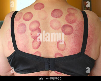 Dunkle rote Kreis Flecken auf dem Rücken der Frau Haut nach medizinischen schröpfen Massage. Stockfoto