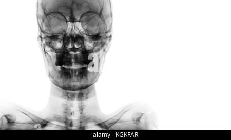 Film x-ray Schädel ap: Zeigen die normalen menschlichen Schädel und leeren Bereich auf der rechten Seite. Stockfoto
