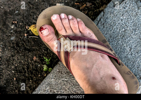 Unfall flip flop cut Fuß Nagel toe haben einen blutigen und blutende Wunde aus der Verletzung nach dem Schlüpfen Stockfoto