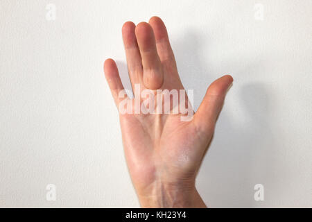 Dupuytren Kontraktur der Deformität: eine Schnur in der Hand (mit einem harten Knötchen an der Basis des Mittelfingers) zieht den Finger in eine verbogene Position. Stockfoto