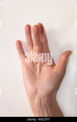 Dupuytren Kontraktur der Deformität: eine Schnur in der Hand (mit einem harten Knötchen an der Basis des Mittelfingers) zieht den Finger in eine verbogene Position. Stockfoto