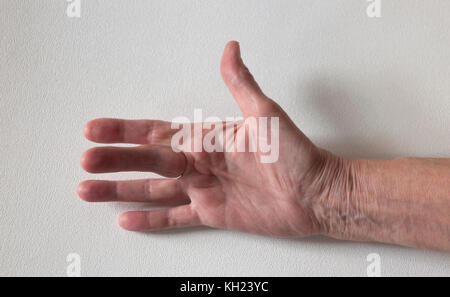 Dupuytren Kontraktur der Deformität: eine Schnur in der Hand (mit einem harten Knötchen an der Basis des Mittelfingers) zieht den Finger in eine verbogene Position. Stockfoto