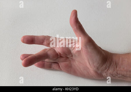 Dupuytren Kontraktur der Deformität: eine Schnur in der Hand (mit einem harten Knötchen an der Basis des Mittelfingers) zieht den Finger in eine verbogene Position. Stockfoto