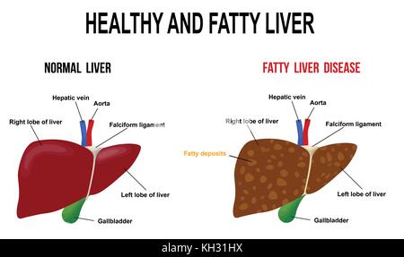 Gesunde und Fettleber, Vector Illustration (für grundlegende medizinische Ausbildung, für Kliniken & Schulen) Stock Vektor